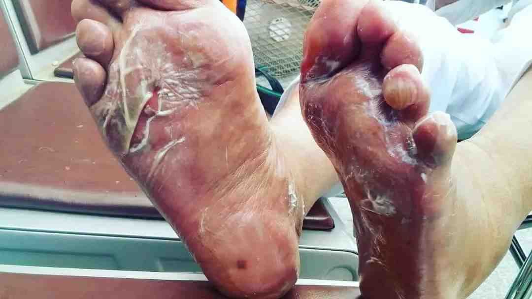 Hindari Kaki Melepuh, Kemenkes Imbau Jemaah Haji Bawa Kantung Khusus Sandal
